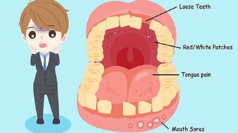 Mouth Cancer 